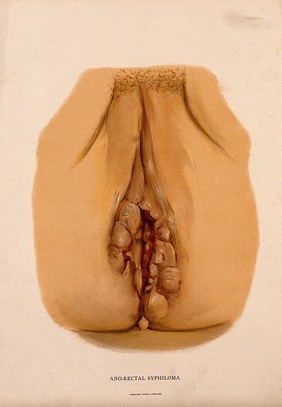 Female genitalia with a skin disease surrounding the anus. Chromolithograph, c. 1888.