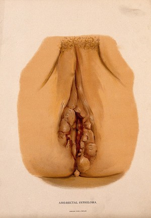 view Female genitalia with a skin disease surrounding the anus. Chromolithograph, c. 1888.