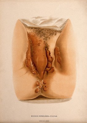 Female genitalia with a skin disease around the labia and the anus. Chromolithograph, c. 1888.