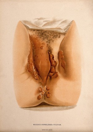 view Female genitalia with a skin disease around the labia and the anus. Chromolithograph, c. 1888.