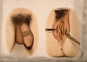 view A penis with a patch of skin disease on the shaft; and female genitalia with a skin disease around the labia and vulva. Chromolithograph, c. 1888.