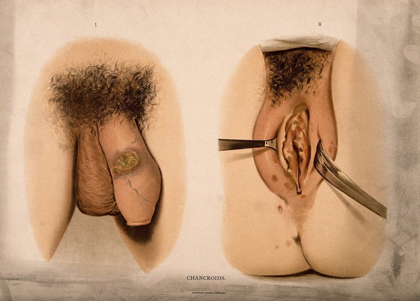 A penis with a patch of skin disease on the shaft; and female genitalia with a skin disease around the labia and vulva. Chromolithograph, c. 1888.