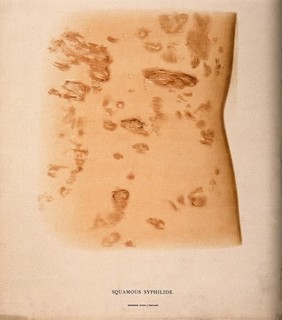 A section of the body (torso?) with a skin disease. Chromolithograph, c. 1888.