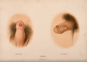 view A penis with a patch of skin disease on the tip of the foreskin; and a penis with a patch of skin disease on the shaft. Chromolithograph, c. 1888.