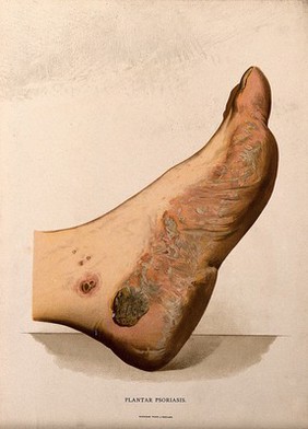 A foot with a skin disease around the sole. Chromolithograph, c. 1888.