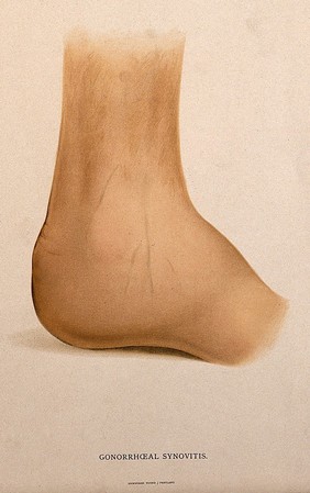 A foot with a skin disease around the ankle. Chromolithograph, c. 1888.