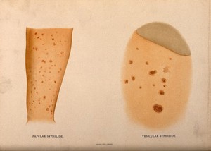 view Two parts of the body covered with a skin disease. Chromolithograph, c. 1888.