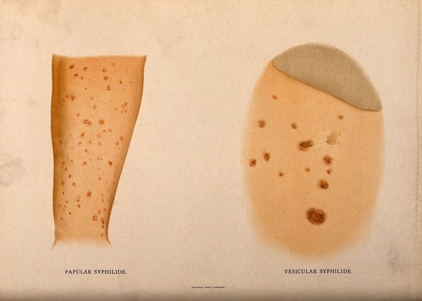 Two parts of the body covered with a skin disease. Chromolithograph, c. 1888.