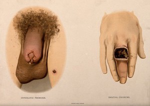 view A diseased penis and top of the thigh with a patch of skin disease; and a hand with a patch of skin disease on the middle finger. Chromolithograph, c. 1888.