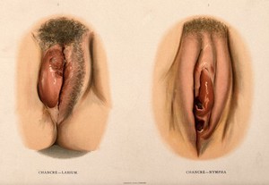 view Two examples of female genitalia with diseased labia. Chromolithograph, c. 1888.