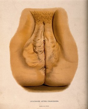 Female genitalia with scar tissue around the labia and anus. Chromolithograph, c. 1888.