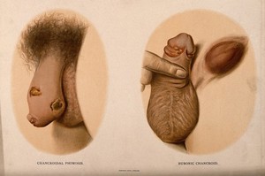 view A penis with patches of skin disease along the shaft; and another with a diseased glans and a lump in the groin. Chromolithograph, c. 1888.