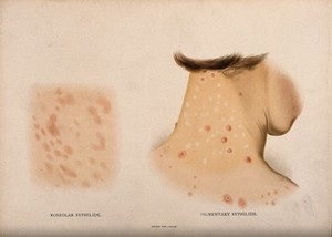 view A patch of skin disease; and a person with a skin disease covering the back of the neck and across the shoulders. Chromolithograph, c. 1888.