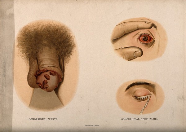 A penis with a skin disease on the glans; and two examples of diseased eyes. Chromolithograph, c. 1888.