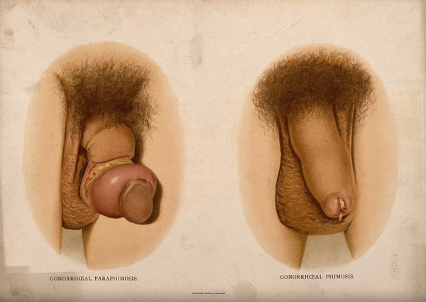 Two examples of a diseased penis: the first with a grossly swollen glans and the second excreting pus. Chromolithograph, c. 1888.