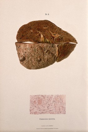 A diseased liver, including a section seen under a microscope, showing symptoms of cirrhosis. Chromolithograph by W. Gummelt, ca. 1897.
