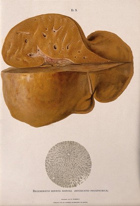 A diseased liver, including a section seen under a microscope, showing symptoms of degeneratio hepatis adiposa. Chromolithograph by W. Gummelt, ca. 1897.