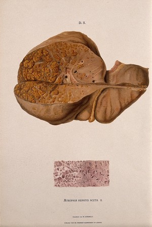 view A diseased liver, including a section seen under a microscope, showing symptoms of atrophia hepatis acuta. Chromolithograph by W. Gummelt, ca. 1897.