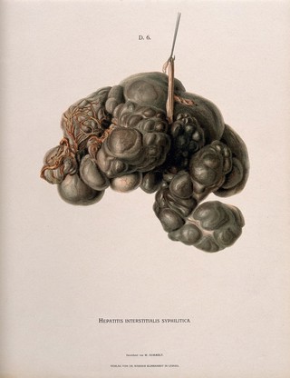 A diseased liver, showing symptoms of hepatitis interstitialis syphilitica. Chromolithograph by W. Gummelt, ca. 1897.