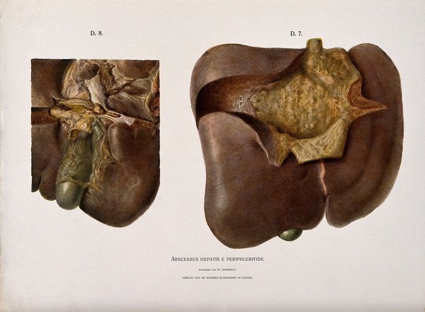 A diseased liver with abcesses: two figures showing symptoms of abscessus hepatis e periphlebitide. Chromolithograph by W. Gummelt, ca. 1897.