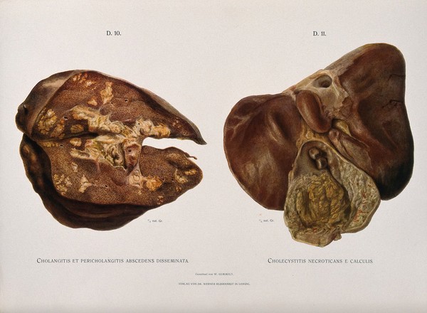 Dissections of diseased livers: two figures showing symptoms of cholangitis and cholecystitis. Chromolithograph by W. Gummelt, ca. 1897.