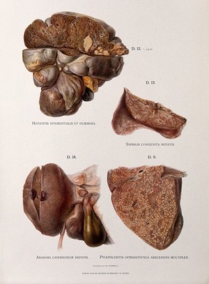 view Dissections of diseased livers: four figures showing symptoms caused by hepatitis, syphilis, anfioma cavernosum and pylephlebitis. Chromolithograph by W. Gummelt, ca. 1897.