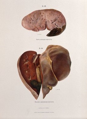 Dissections of diseased livers: two figures showing symptoms of amyloidosis hepatis and haemo-siderosis hepatis. Chromolithograph by W. Gummelt, ca. 1897.