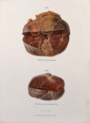 view Dissections of the spleen affected by infarction of the splenic artery. Chromolithograph by W. Gummelt, ca. 1897.