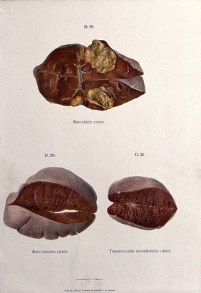 Dissections of the diseased spleen: three figures. Chromolithograph by W. Gummelt, ca. 1897.