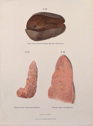 view Dissections of diseased spleen: three figures. Chromolithograph by W. Gummelt, ca. 1897.