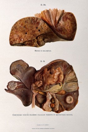 Dissections of a diseased liver and gall bladder: two figures. Chromolithograph by W. Gummelt, ca. 1897.