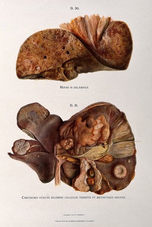 view Dissections of a diseased liver and gall bladder: two figures. Chromolithograph by W. Gummelt, ca. 1897.