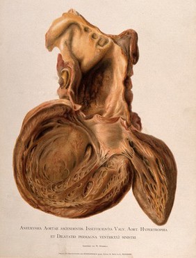 A diseased heart, showing an aortic aneursym with an enlarged left ventricle. Chromolithograph by W. Gummelt, ca. 1897.