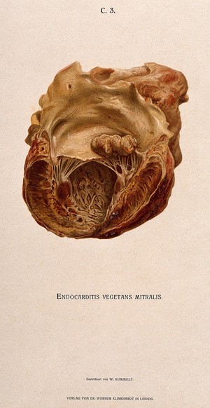 view A diseased heart affected by a form of endocarditis. Chromolithograph by W. Gummelt, ca. 1897.