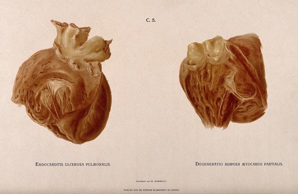 Dissections of two diseased hearts. Chromolithograph by W. Gummelt, ca. 1897.