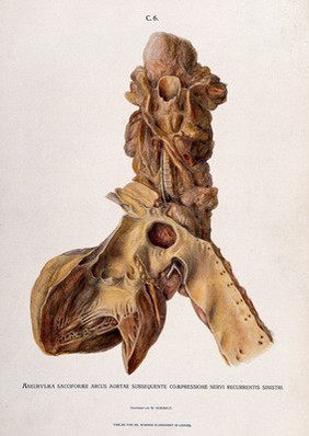 A diseased heart with an aortic aneurysm. Chromolithograph by W. Gummelt, ca. 1897.