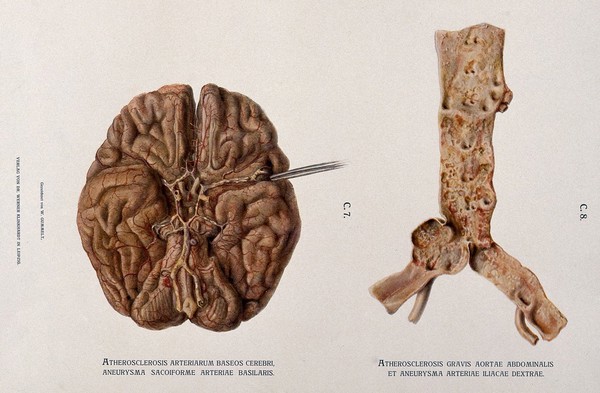 Underside of a brain, shown beside a dissection of the abdominal aorta and left iliac artery, both showing symptoms of atherosclerosis and aneurysm. Chromolithograph by W. Gummelt, ca. 1897.