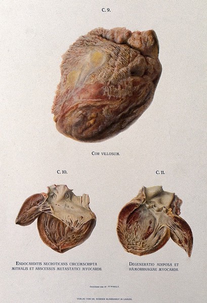 Dissections of diseased hearts: three figures, including hearts affected by forms of endocarditis and myocardial haemorrhage. Chromolithograph by W. Gummelt, ca. 1897.