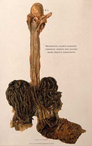 view An oesophagus, stomach and duodenum after death from drinking sulphuric acid. Chromolithograph by W. Gummelt, ca. 1897.