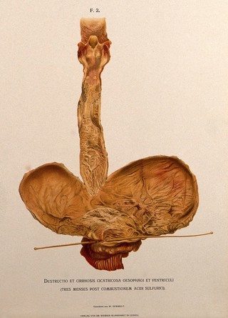 A diseased oesophagus. Chromolithograph by W. Gummelt, ca. 1897.