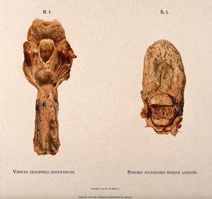 view Dissections of a diseased oesophagus and tongue: two figures. Chromolithograph by W. Gummelt, ca. 1897.