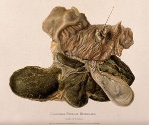 view A diseased duodenum. Chromolithograph by W. Gummelt, ca. 1897.