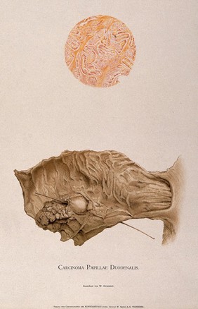 A diseased duodenum, with a detail showing cells as seen through a microscope. Chromolithograph by W. Gummelt, ca. 1897.