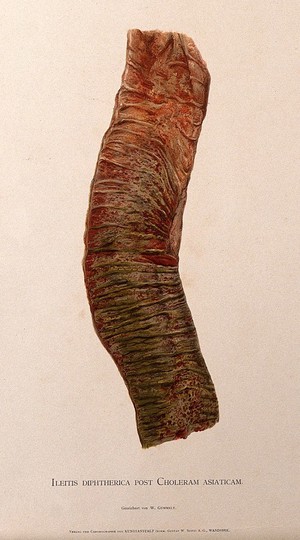 view Part of the intestine showing signs of ileitis diphtherica following cholera asiatica. Chromolithograph by W. Gummelt, ca. 1897.