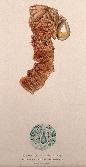 view Dissection of a diseased intestine showing signs of cholera asiatica, with a detail showing a section as seen under a microscope. Chromolithograph by W. Gummelt, ca. 1897.