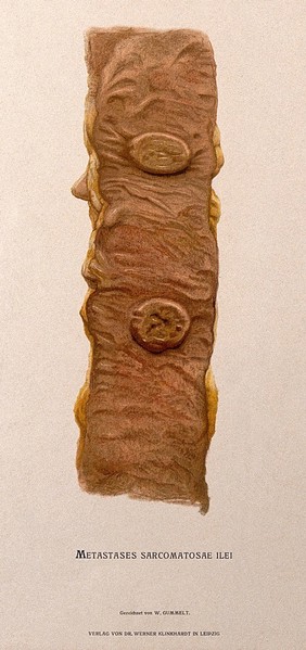Dissection of a diseased intestine. Chromolithograph by W. Gummelt, ca. 1897.