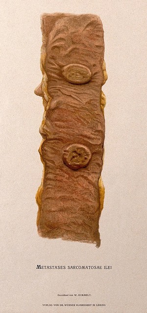 view Dissection of a diseased intestine. Chromolithograph by W. Gummelt, ca. 1897.