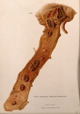 Dissection of a diseased intestine, showing signs of typhus. Chromolithograph by W. Gummelt, ca. 1897.