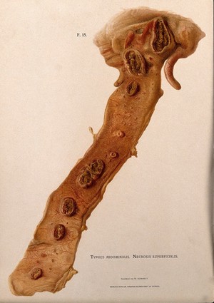 view Dissection of a diseased intestine, showing signs of typhus. Chromolithograph by W. Gummelt, ca. 1897.