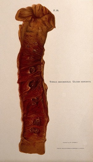 view Dissection of a diseased intestine, showing signs of typhus. Chromolithograph by W. Gummelt, ca. 1897.